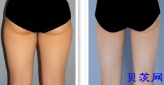 大腿吸脂术一次吸多少脂肪量好?